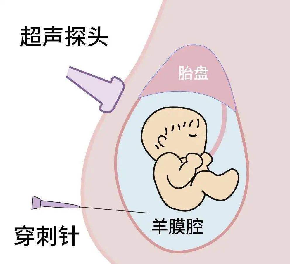 羊水胎儿亲子鉴定